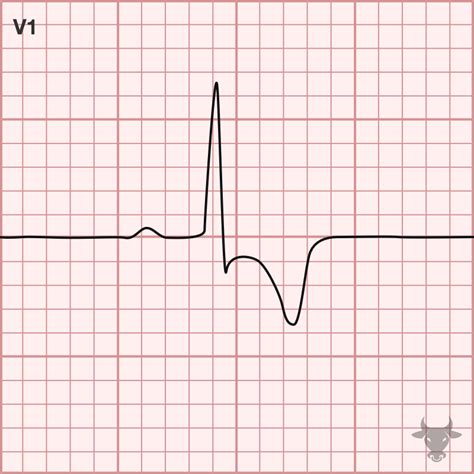 Right heart strain 